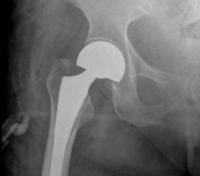 Hemiarthroplasty 1