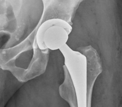 Total Hip Arthroplasty 2